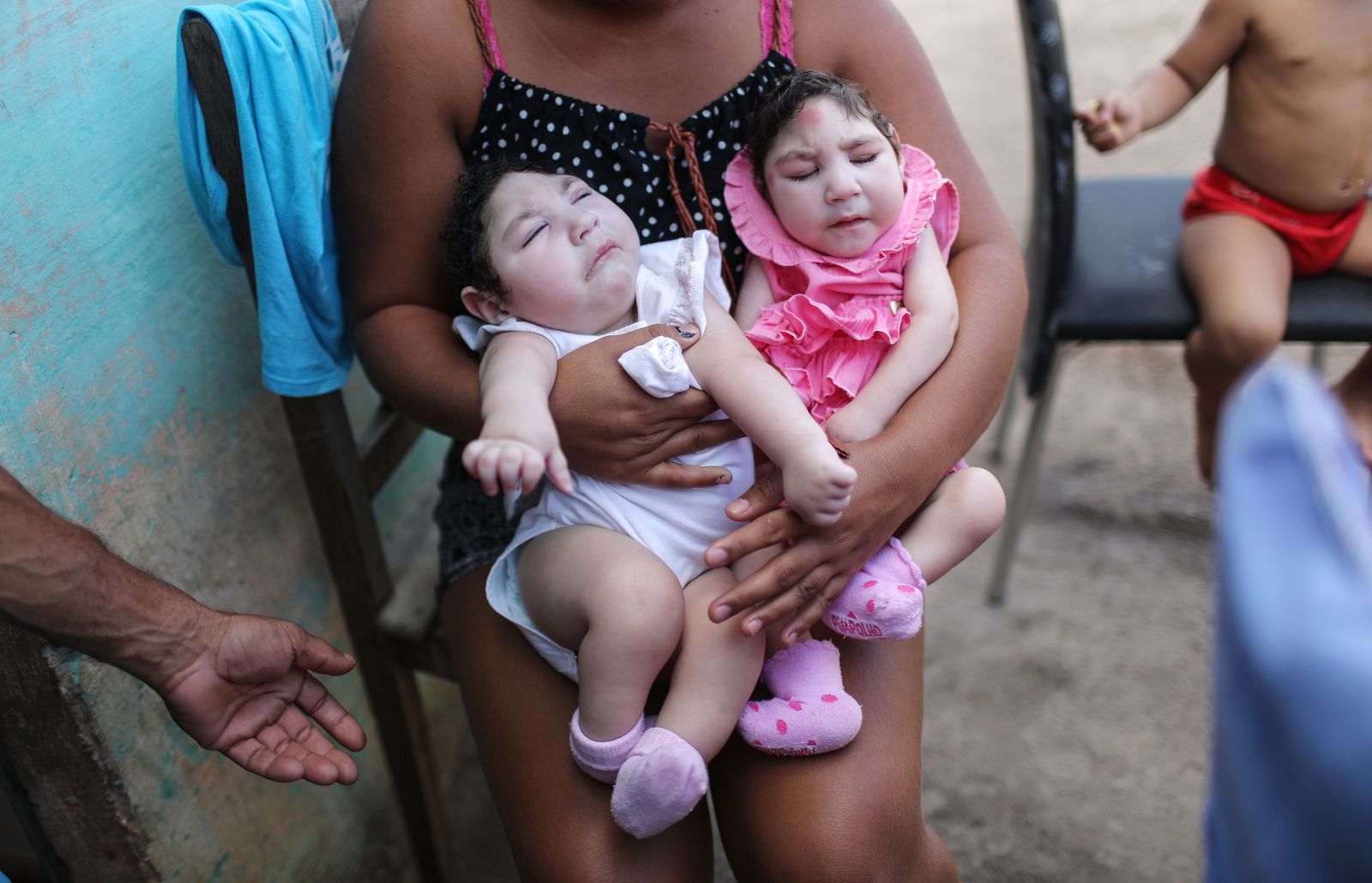 AFP-หัวเล็ก-ภาวะหัวเล็ก-ศีรษะเล็ก-ไมโครซีฟาลี-ไมโครเซฟาลี-microcephaly-ซิกา-ไวรัส-เด็กบราซิล