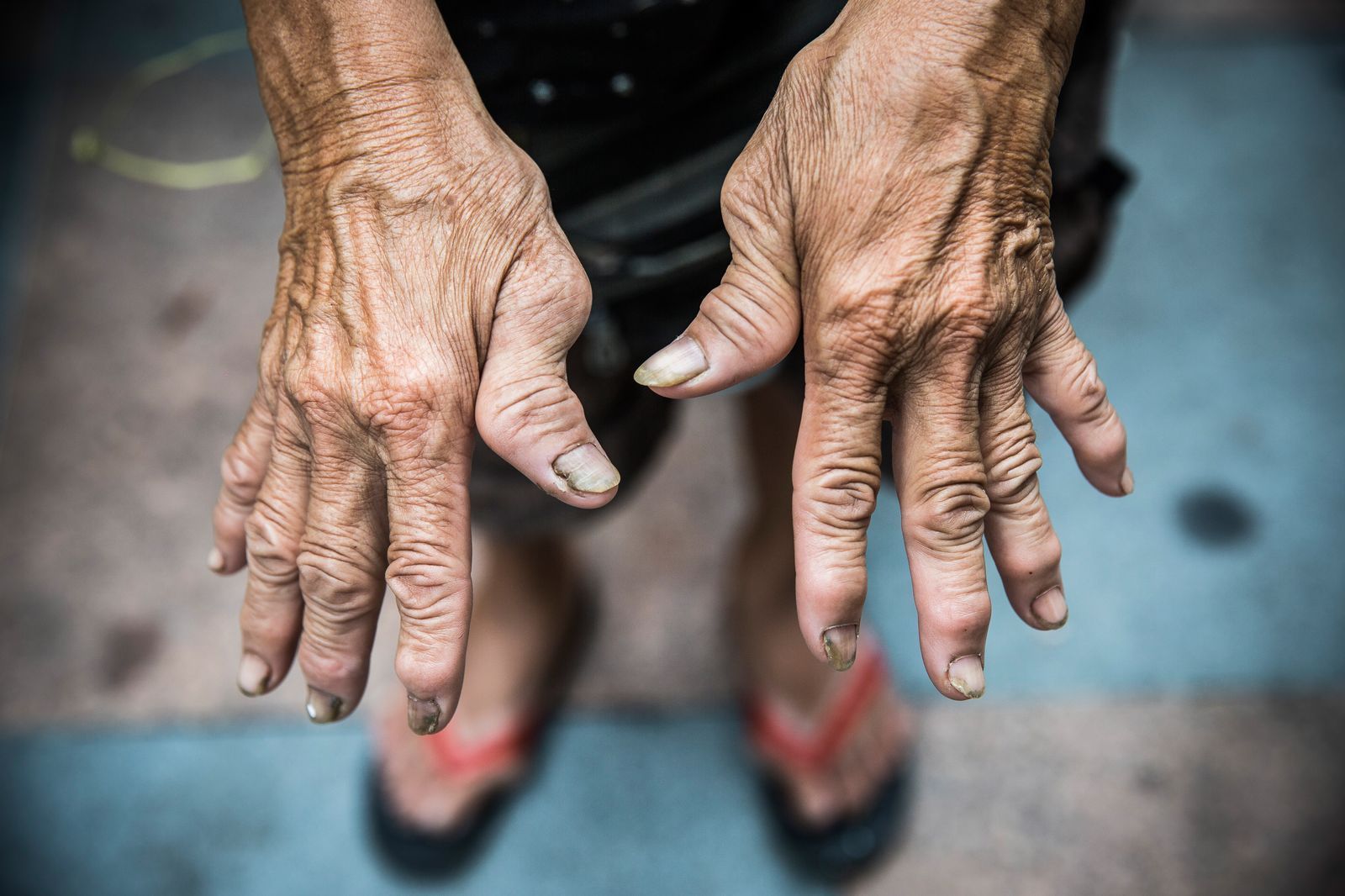 AFP-มือคนแก่-สูงอายุ-นิ้วคด